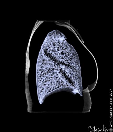 CT 3D thorax 2